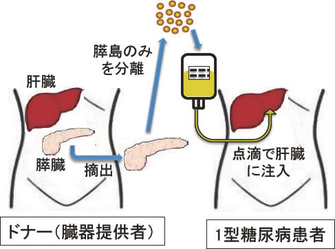 膵島移植の方法（他者からの移植）