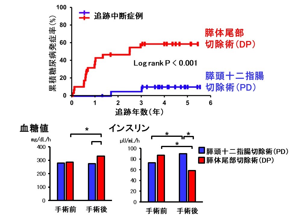 膵臓部分切除術後の糖尿病発症に関与する因子の解明