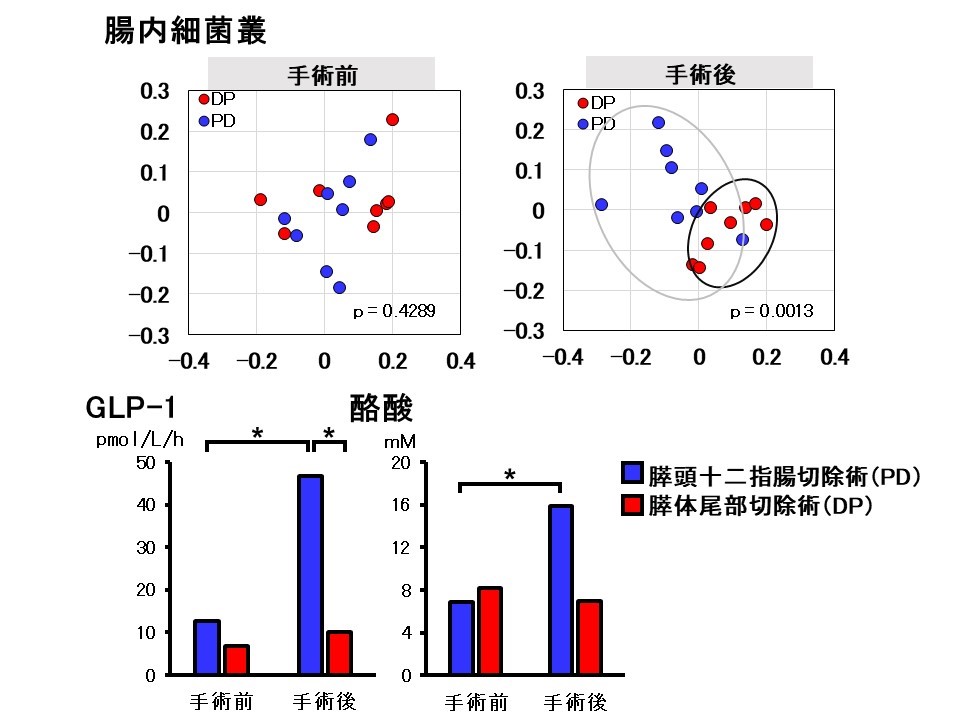 膵臓部分切除術後の糖尿病発症に関与する因子の解明