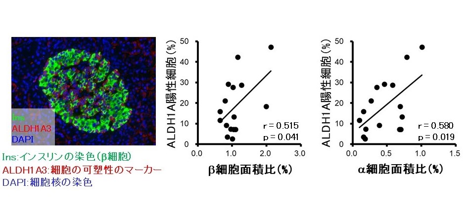 膵臓部分切除術後の糖尿病発症に関与する因子の解明