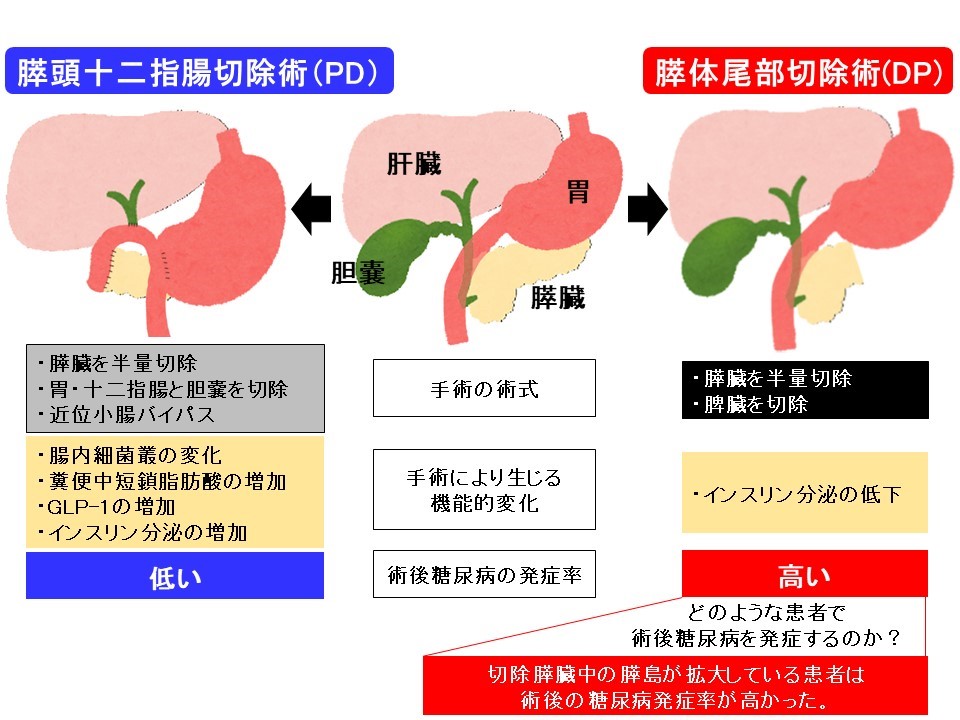 膵臓部分切除術後の糖尿病発症に関与する因子の解明